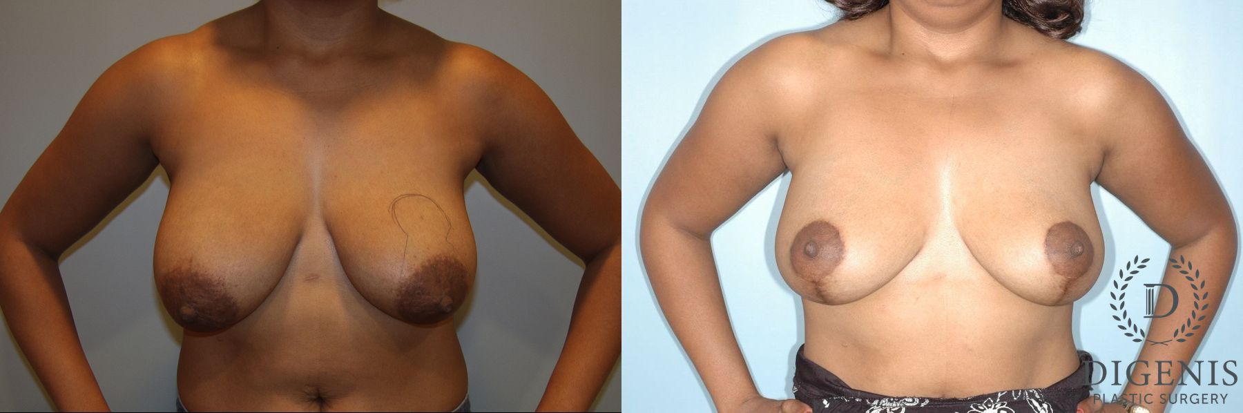 Before and after Breast Lift with or without Implants case 35083
