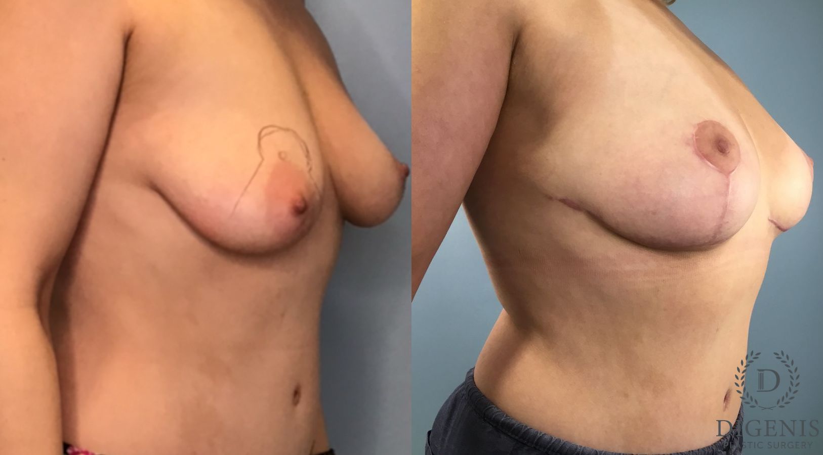 Before and after Breast Lift with or without Implants case 43491 - Angle 4