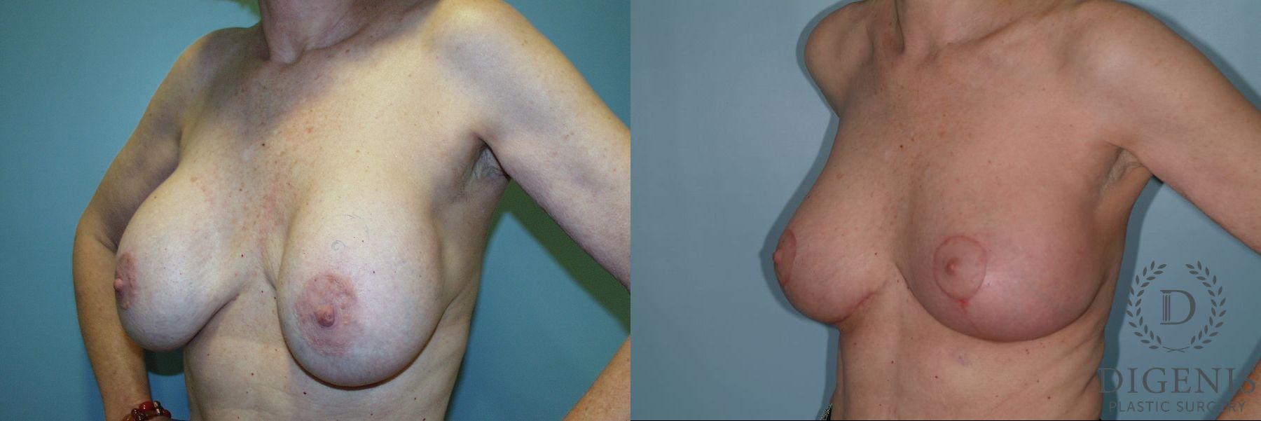 Before and after Breast Lift with or without Implants case 35107 - Angle 4