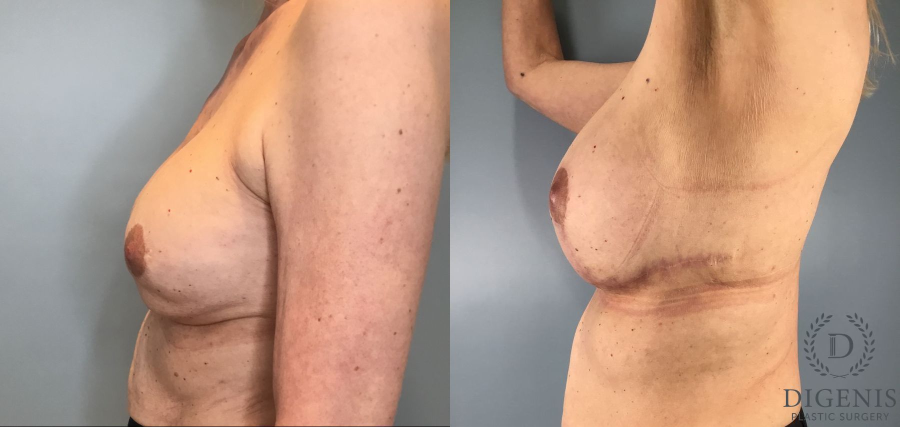 Before and after Breast Lift with or without Implants case 41688 - Angle 3