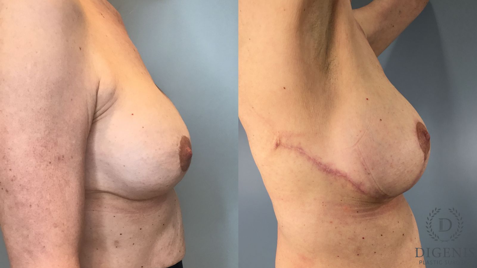 Before and after Breast Lift with or without Implants case 41688 - Angle 5