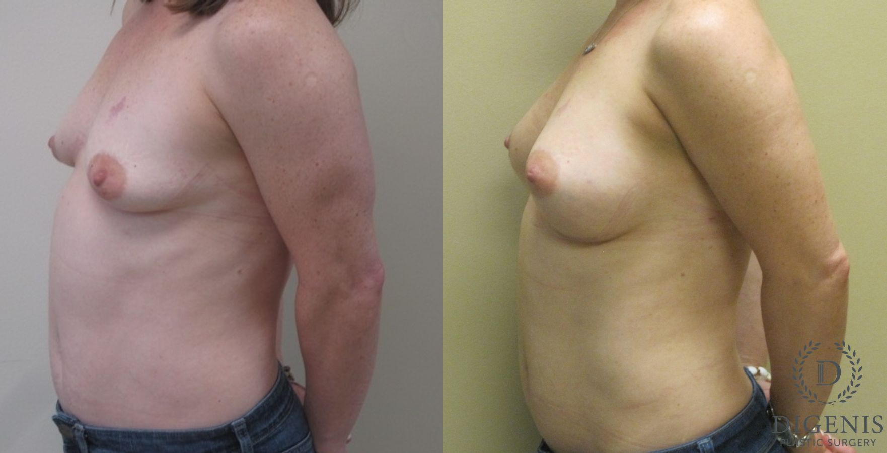 Before and after Breast Lift with or without Implants case 35069 - Angle 5