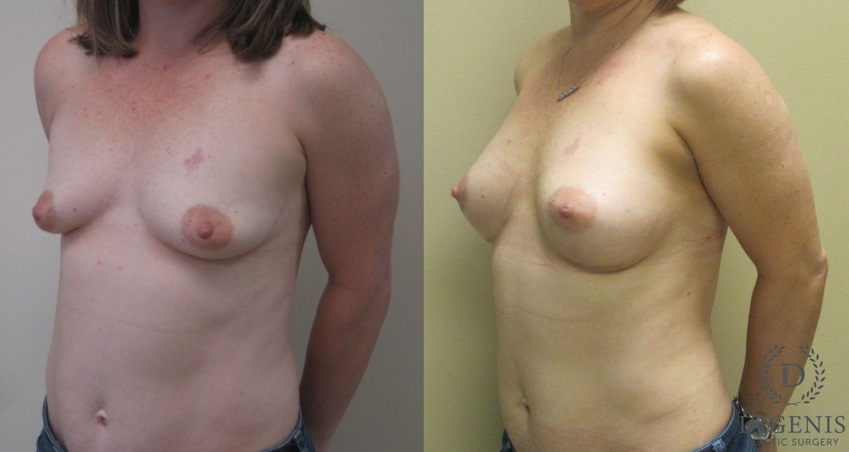 Before and after Breast Lift with or without Implants case 35069 - Angle 4
