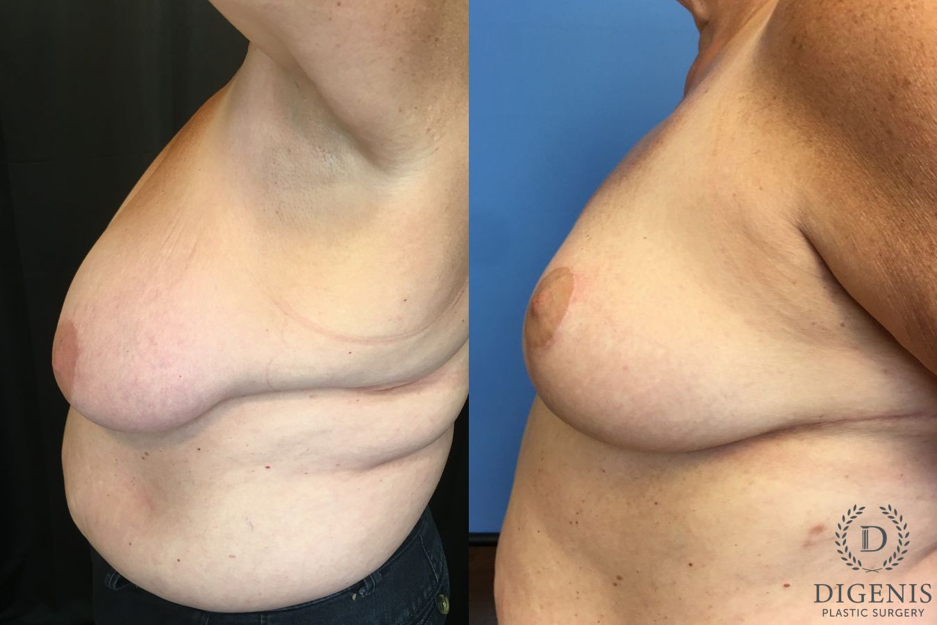 Before and after Breast Reduction case 35164 - Angle 5