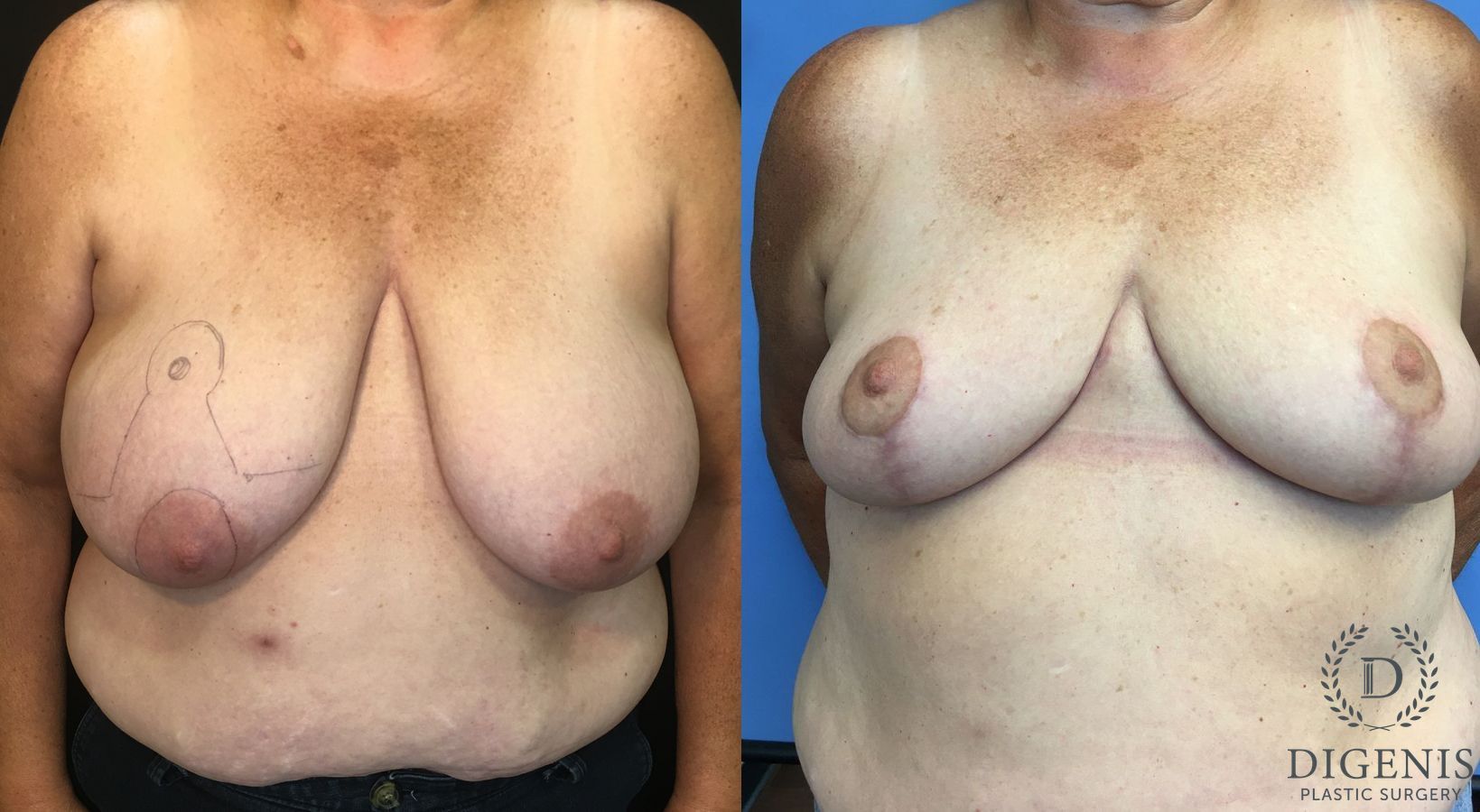 Before and after Breast Reduction case 35164