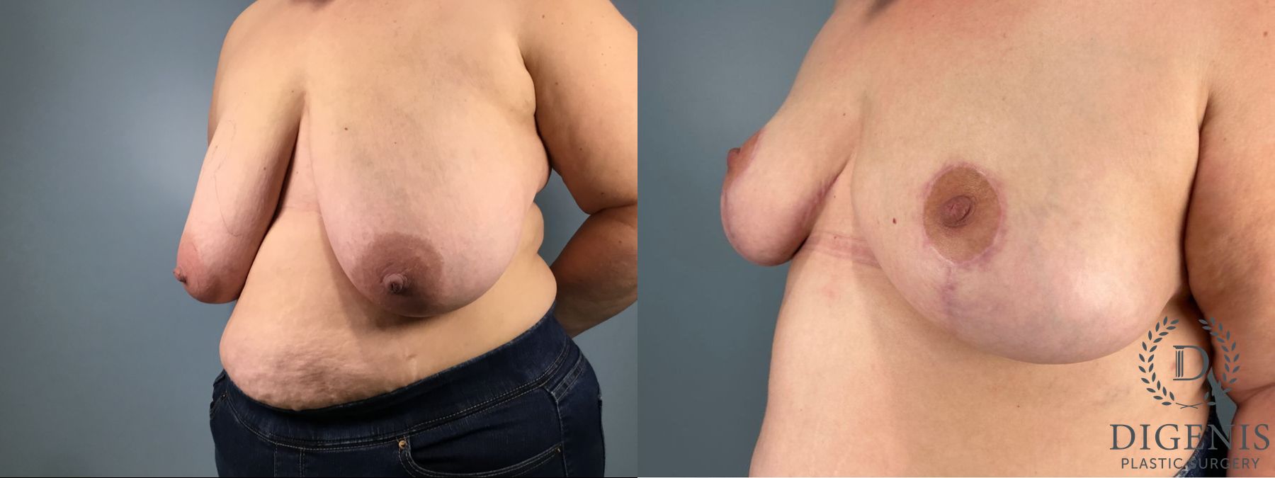 Before and after Breast Reduction case 49949 - Angle 2