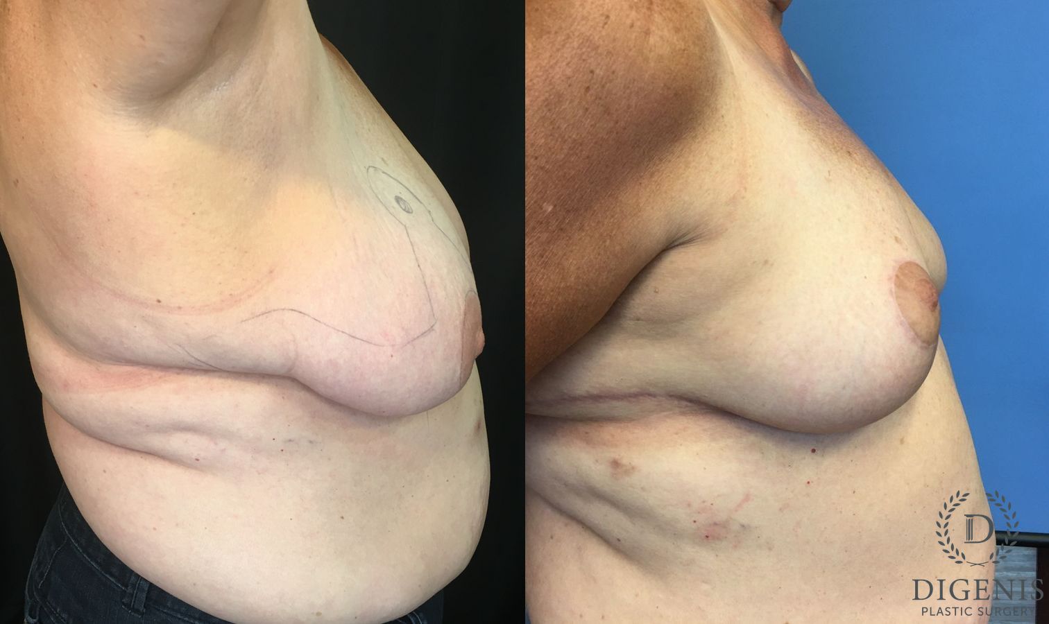 Before and after Breast Reduction case 35164 - Angle 3