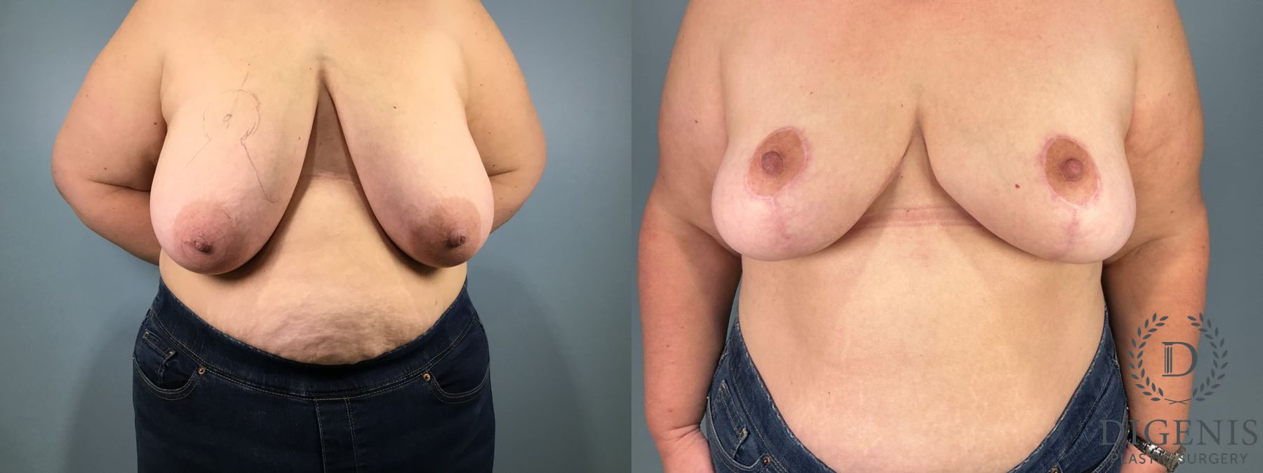Before and after Breast Reduction case 49949