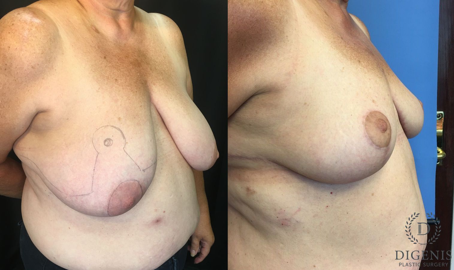 Before and after Breast Reduction case 35164 - Angle 2