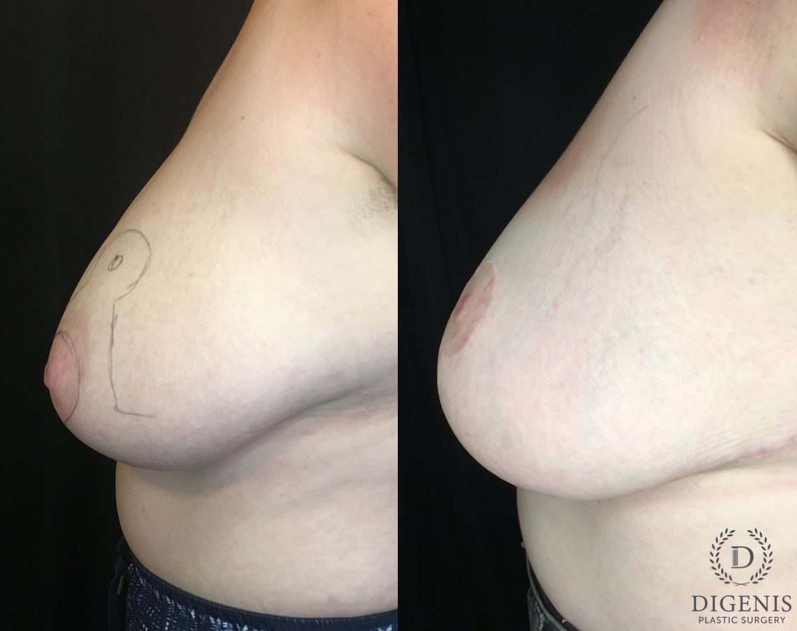 Before and after Breast Reduction case 35186 - Angle 5
