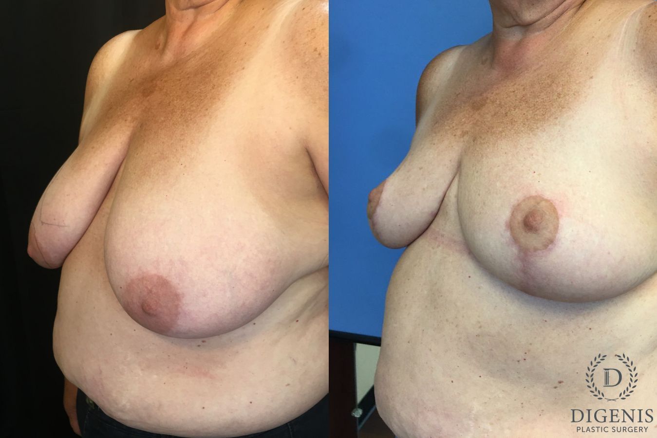 Before and after Breast Reduction case 35164 - Angle 4
