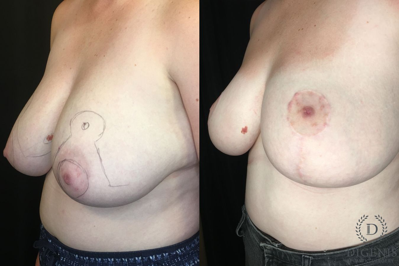 Before and after Breast Reduction case 35186 - Angle 4