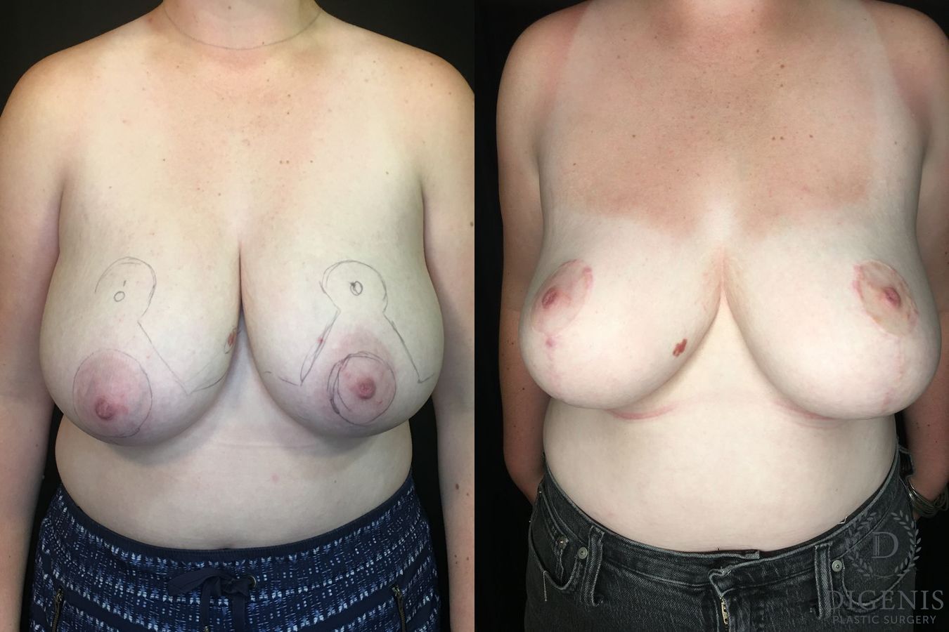 Before and after Breast Reduction case 35186