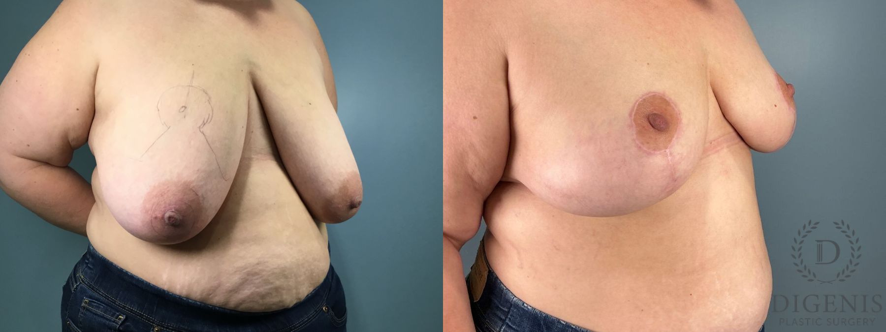 Before and after Breast Reduction case 49949 - Angle 4