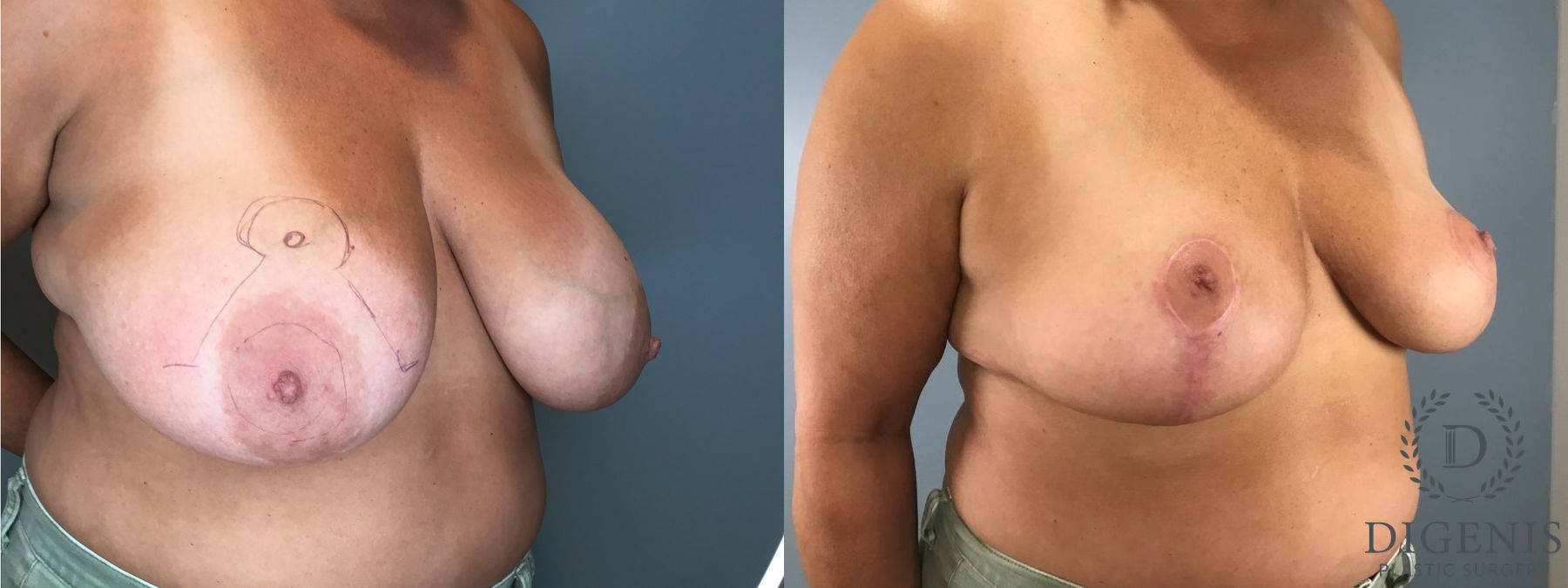 Before and after Breast Lift with or without Implants case 43076 - Angle 4