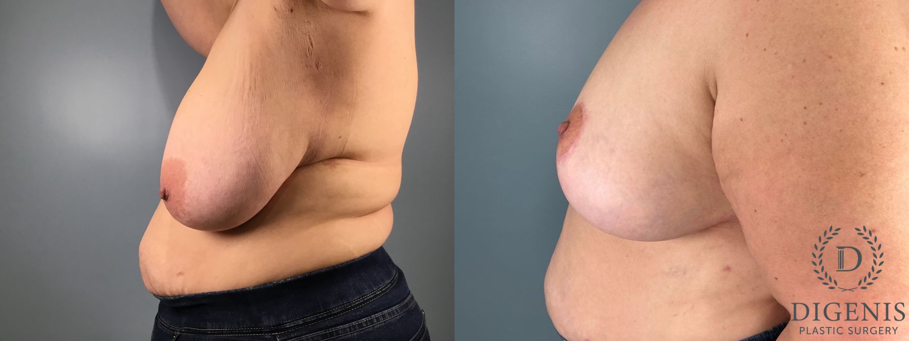 Before and after Breast Reduction case 49949 - Angle 3