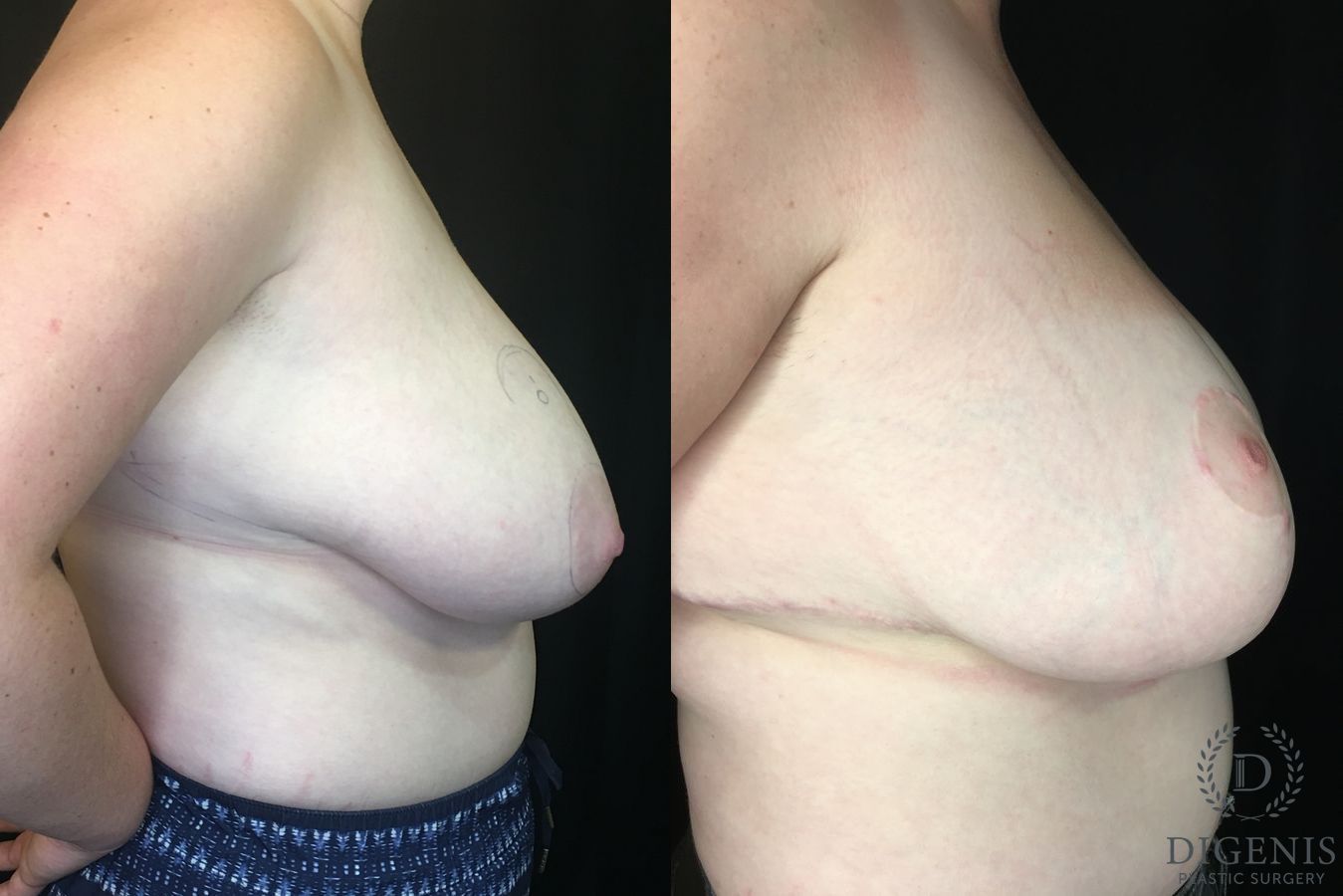 Before and after Breast Reduction case 35186 - Angle 3