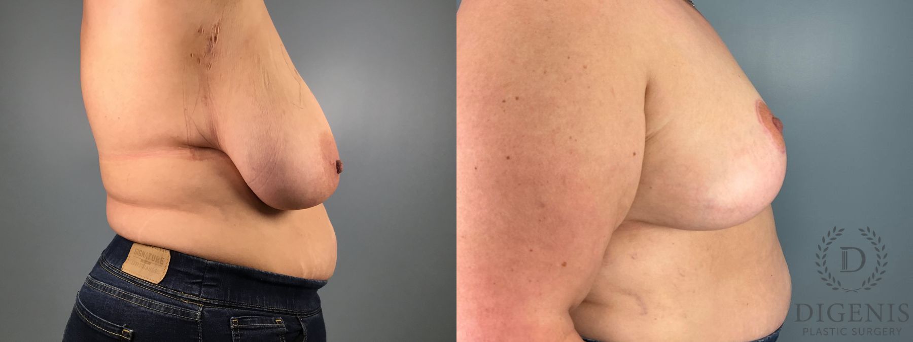 Before and after Breast Reduction case 49949 - Angle 5