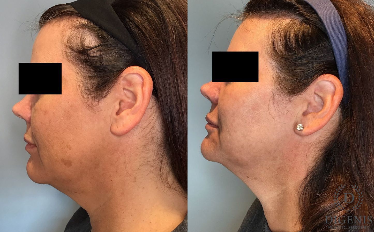 Before and after BroadBand Light (BBL™) case 35122 - Angle 2