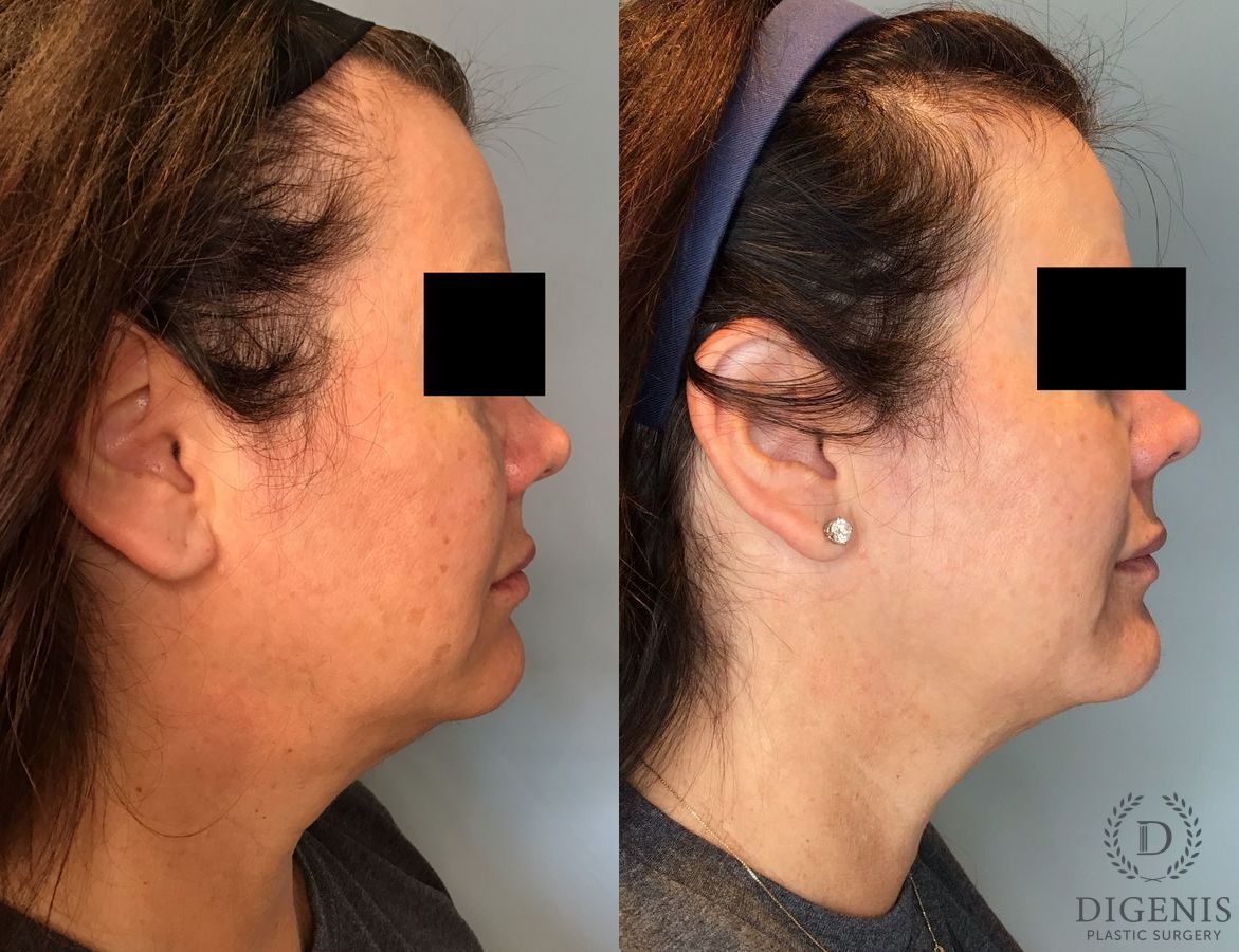 Before and after BroadBand Light (BBL™) case 35122