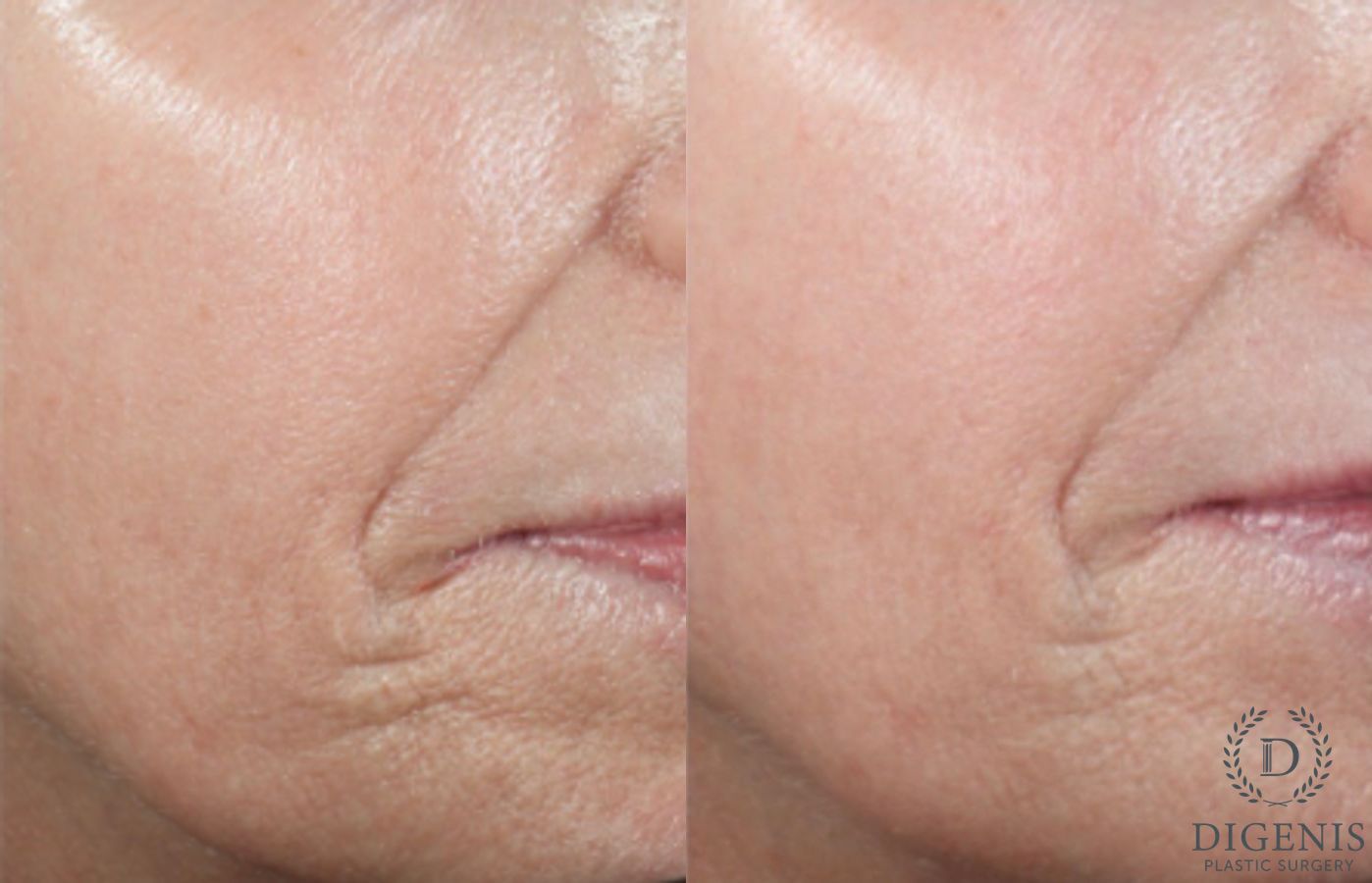 Before and after Chemical Peel case 43126