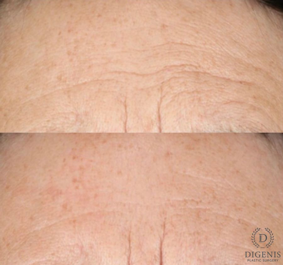Before and after Chemical Peel case 43128