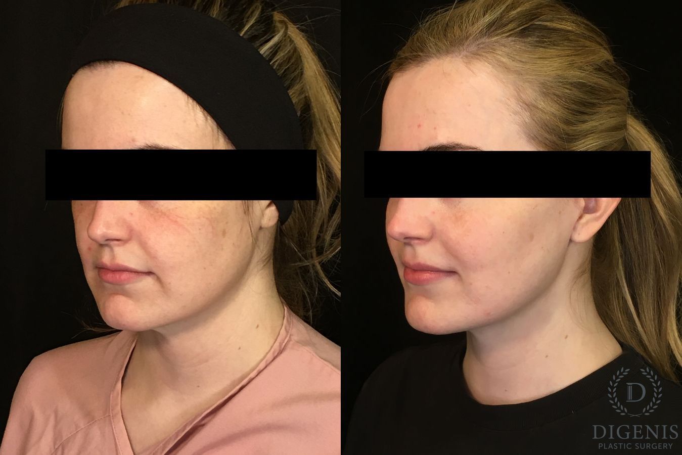 Before and after Digenis Refresh Lift case 35075 - Angle 2
