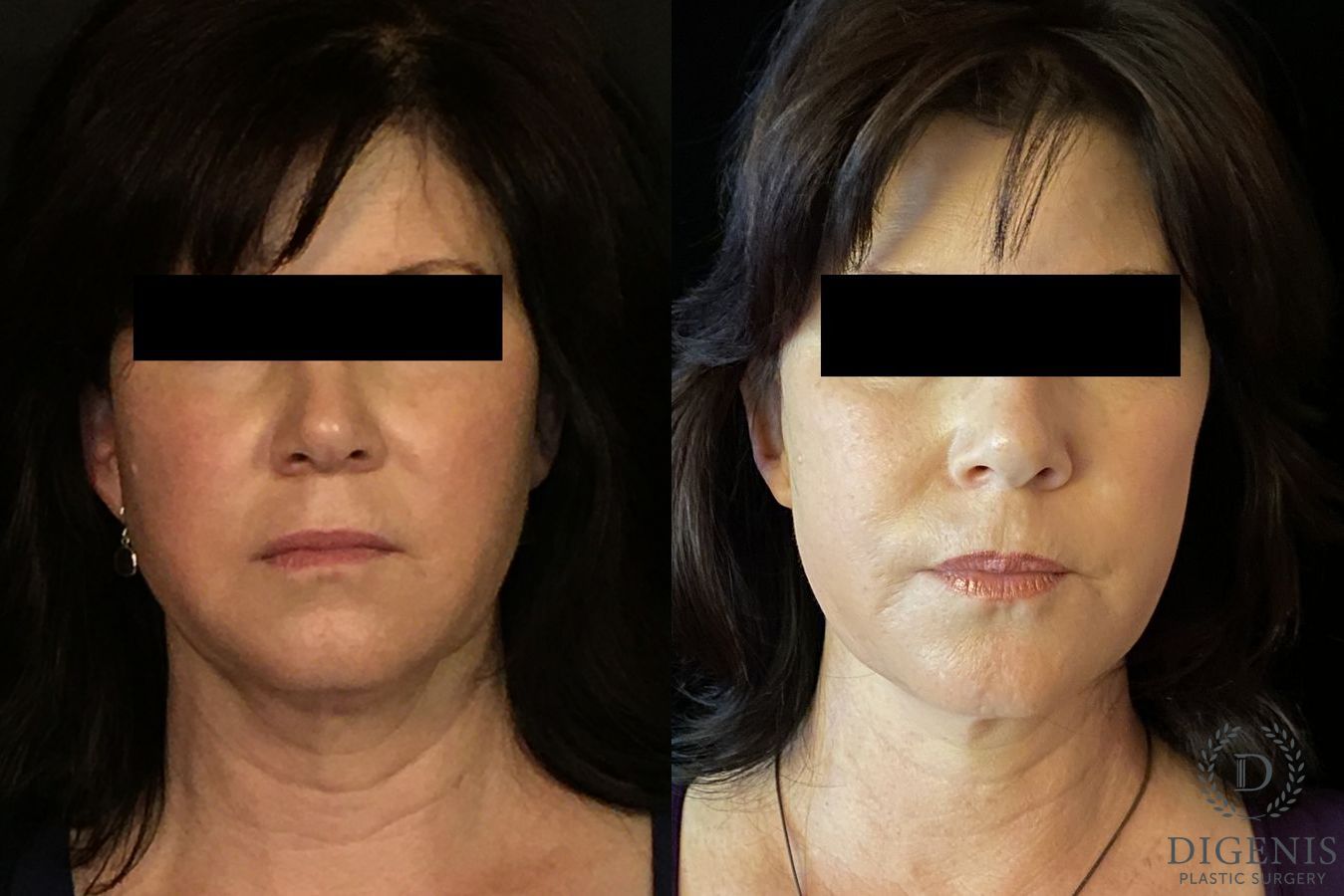 Before and after Digenis Refresh Lift case 35096