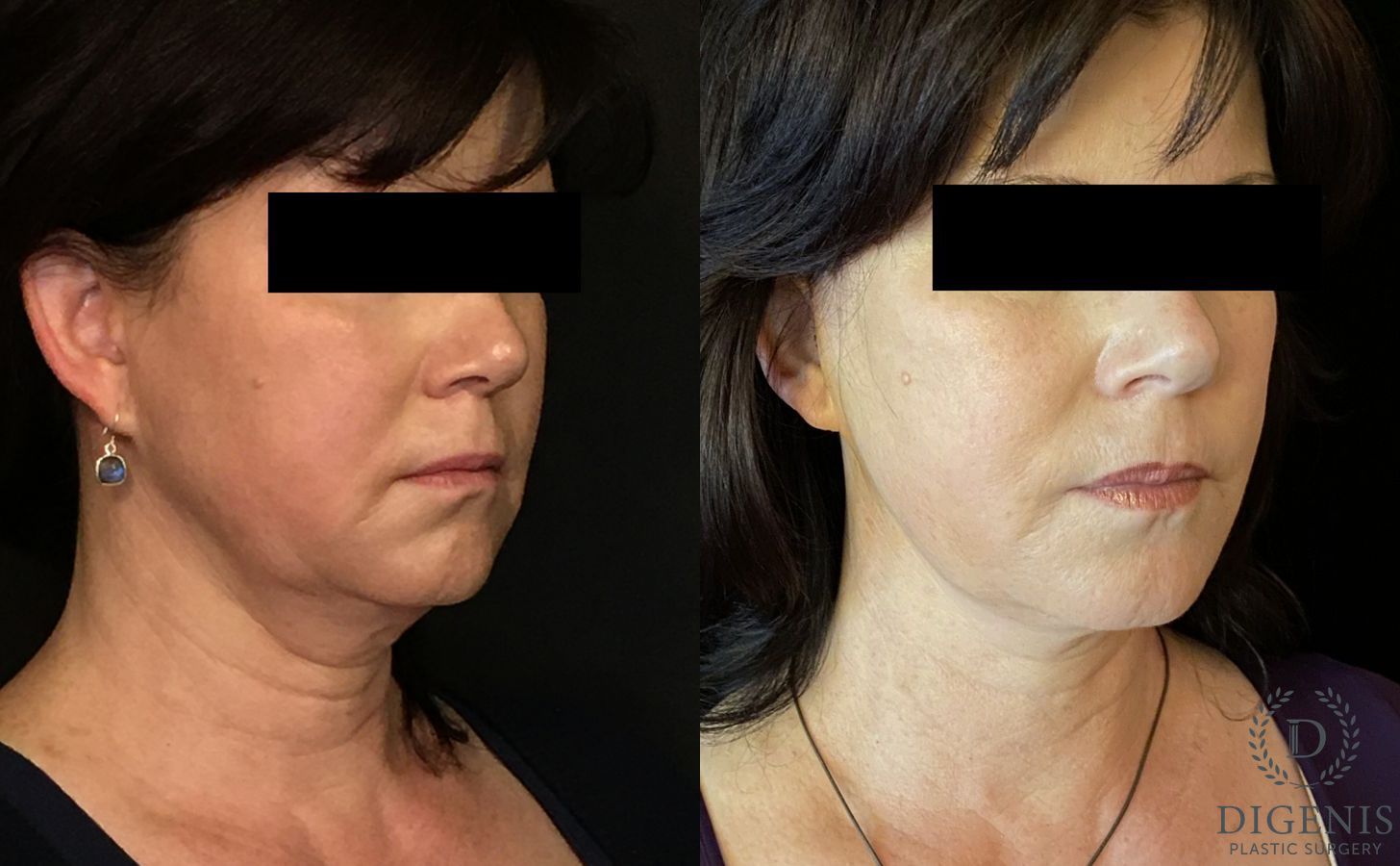 Before and after Digenis Refresh Lift case 35096 - Angle 2