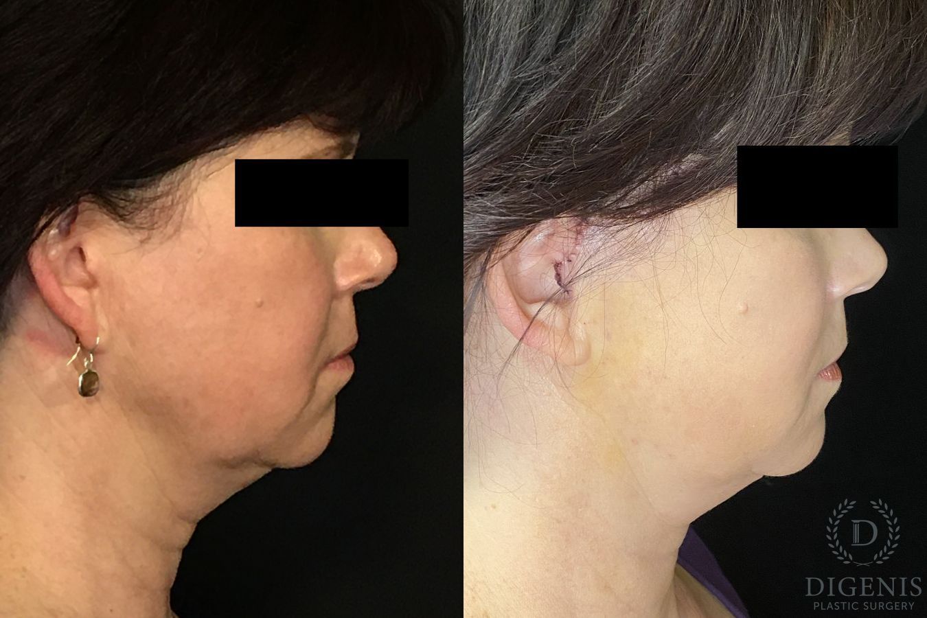 Before and after Digenis Refresh Lift case 35096 - Angle 3