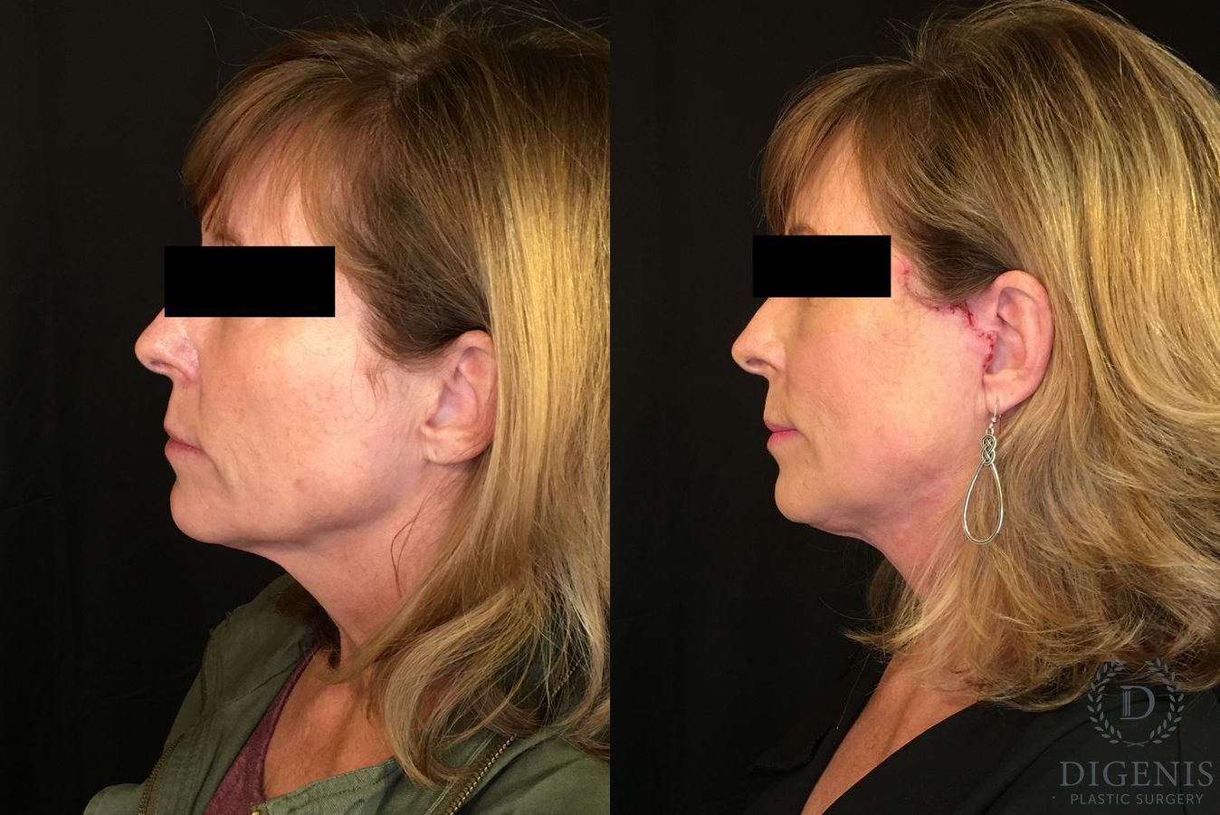 Before and after Digenis Refresh Lift case 35076 - Angle 5