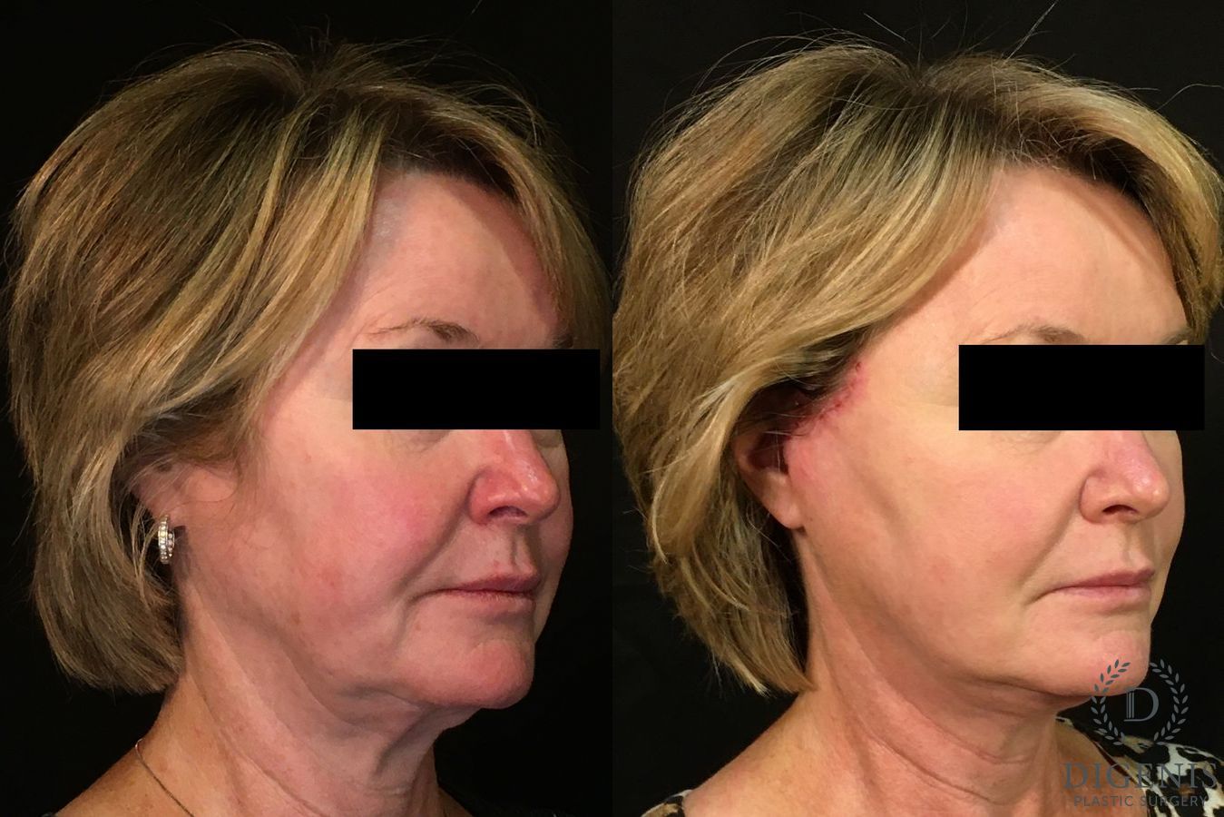 Before and after Digenis Refresh Lift case 35048 - Angle 2