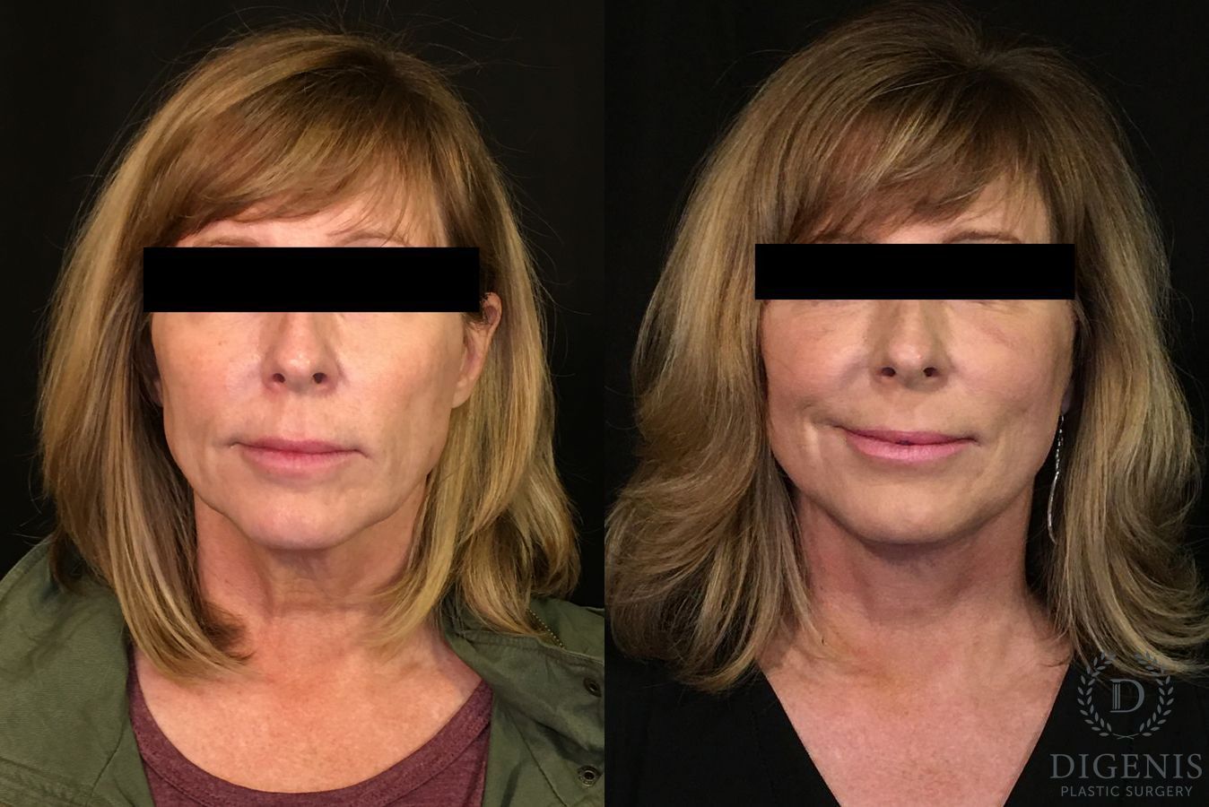 Before and after Digenis Refresh Lift case 35076