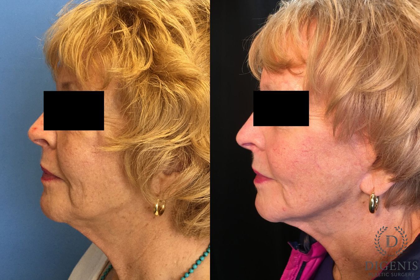 Before and after Digenis Refresh Lift case 35155 - Angle 5