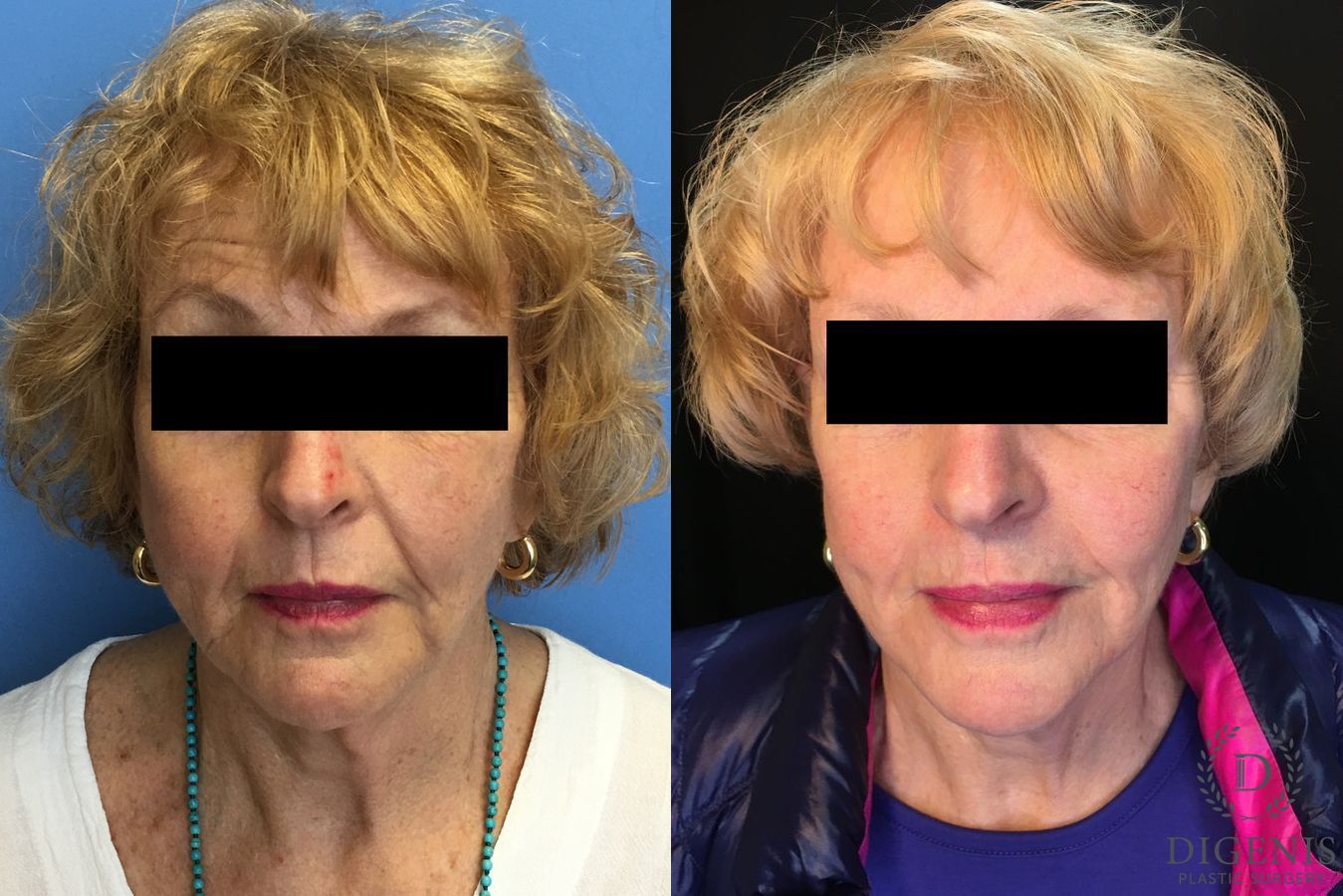 Before and after Digenis Refresh Lift case 35155