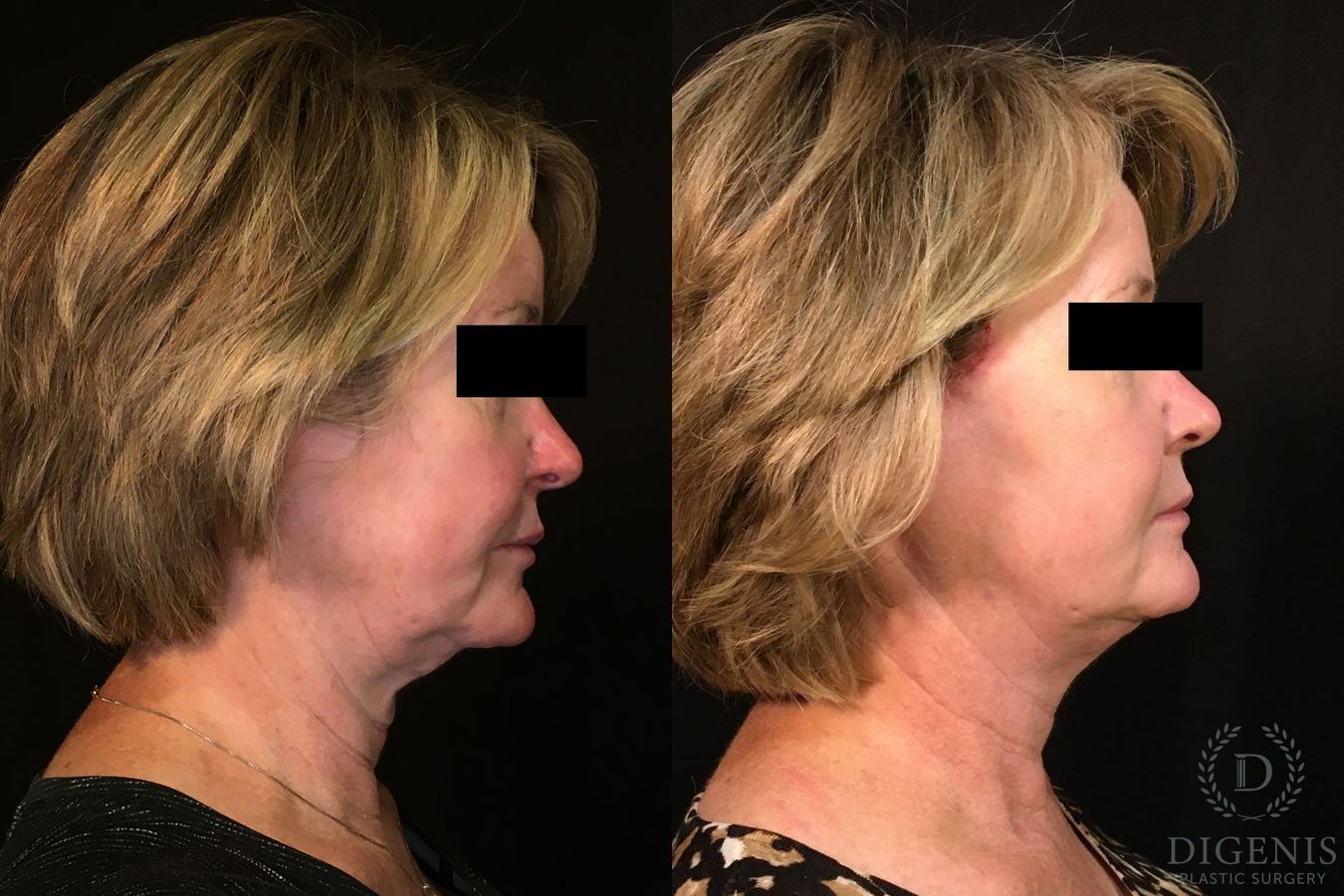 Before and after Digenis Refresh Lift case 35048 - Angle 3