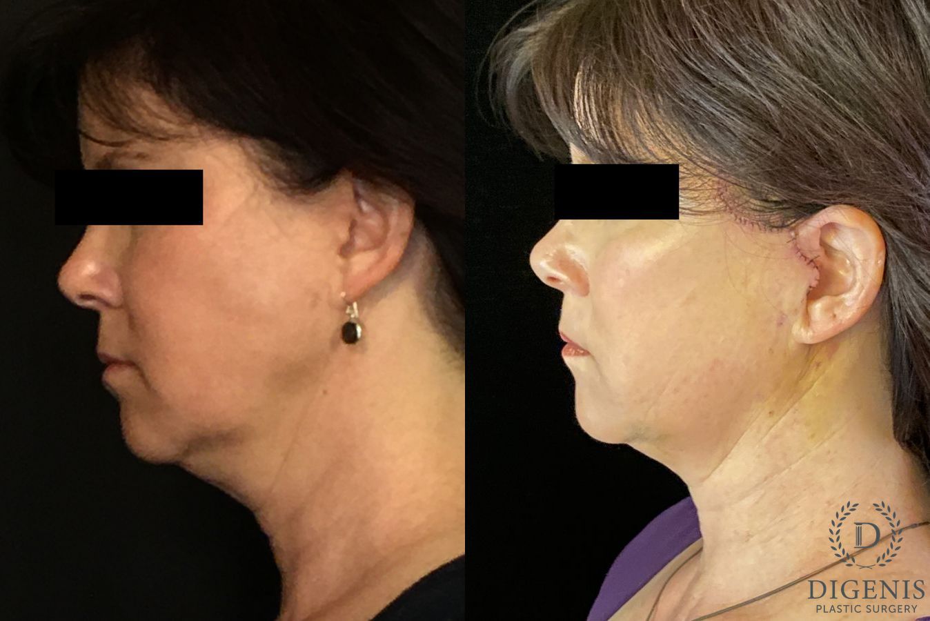 Before and after Digenis Refresh Lift case 35096 - Angle 5