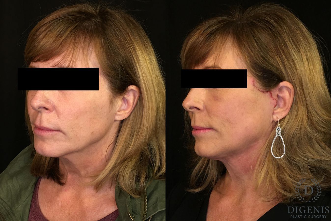 Before and after Digenis Refresh Lift case 35076 - Angle 4