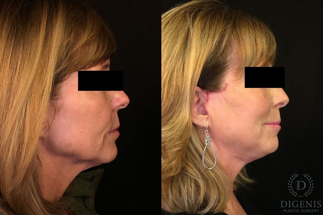 Before and after Digenis Refresh Lift case 35076 - Angle 3