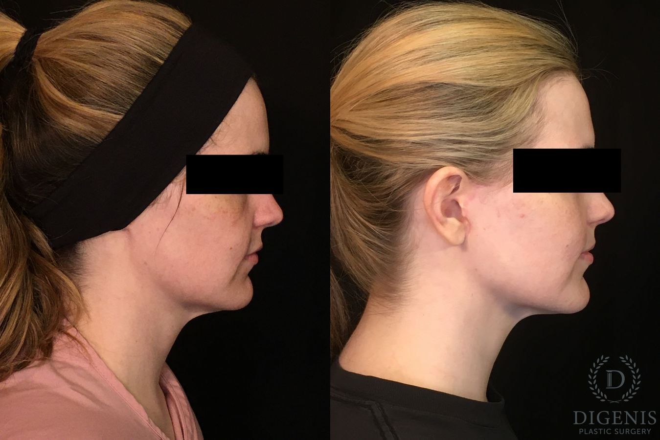 Before and after Digenis Refresh Lift case 35075 - Angle 5