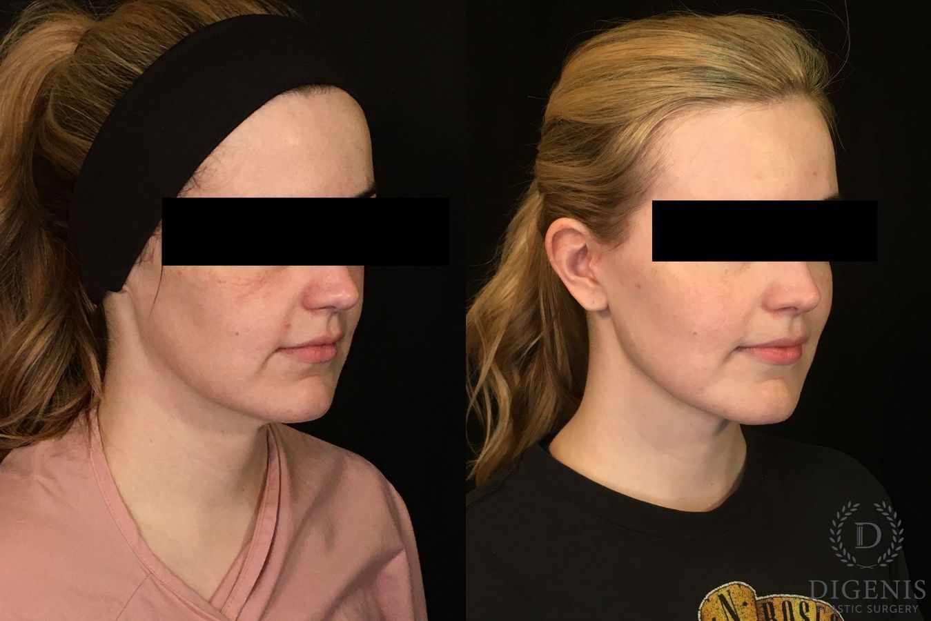 Before and after Digenis Refresh Lift case 35075 - Angle 4