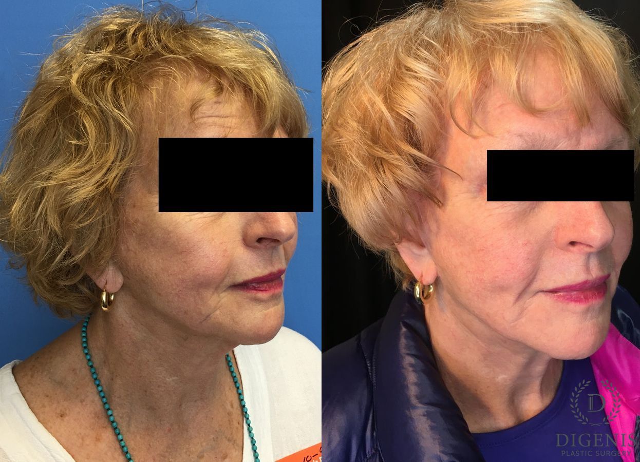 Before and after Digenis Refresh Lift case 35155 - Angle 2