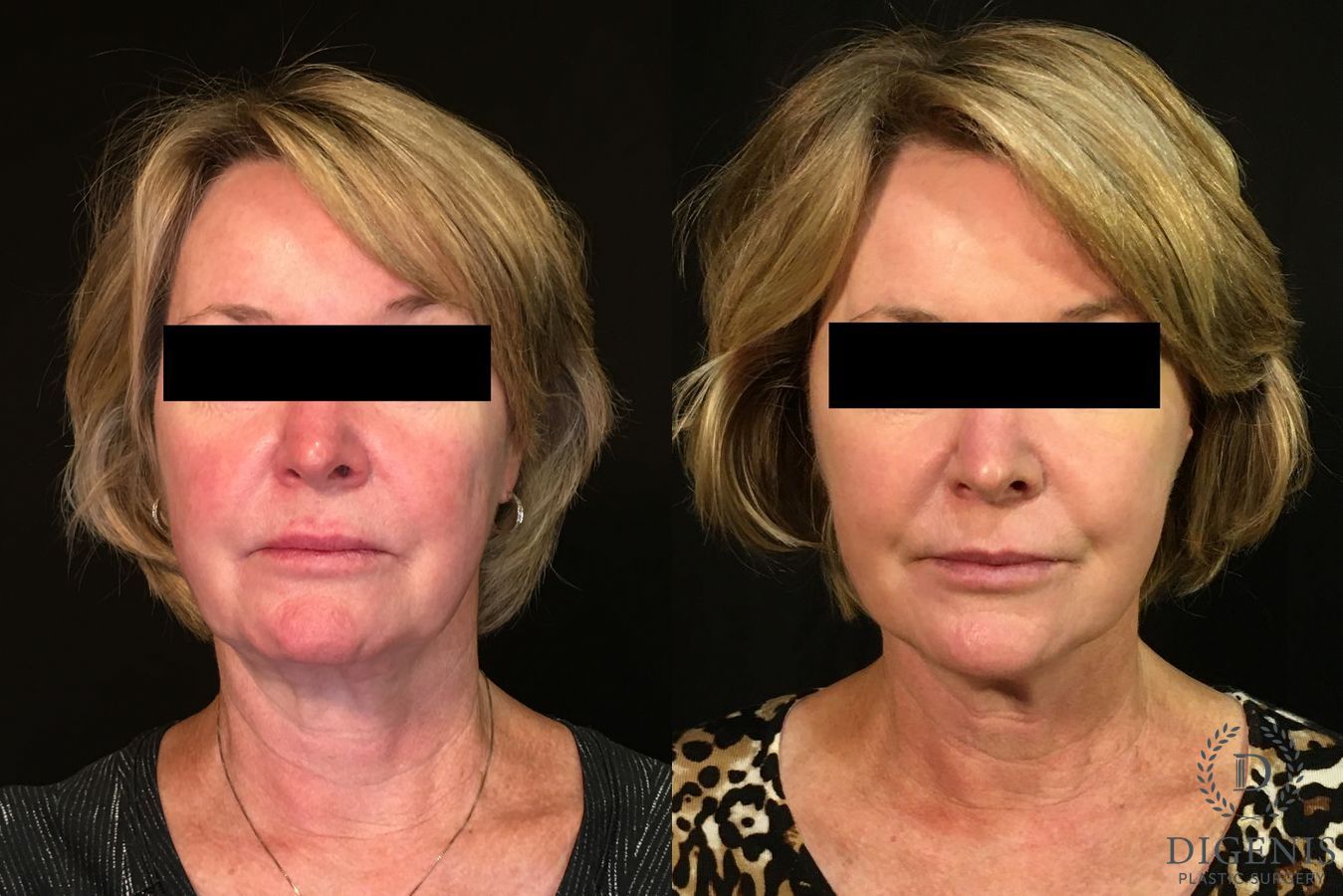 Before and after Digenis Refresh Lift case 35048