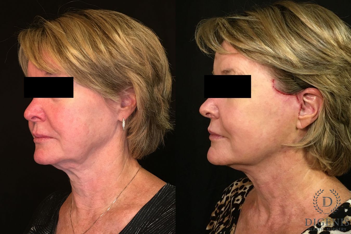 Before and after Digenis Refresh Lift case 35048 - Angle 4