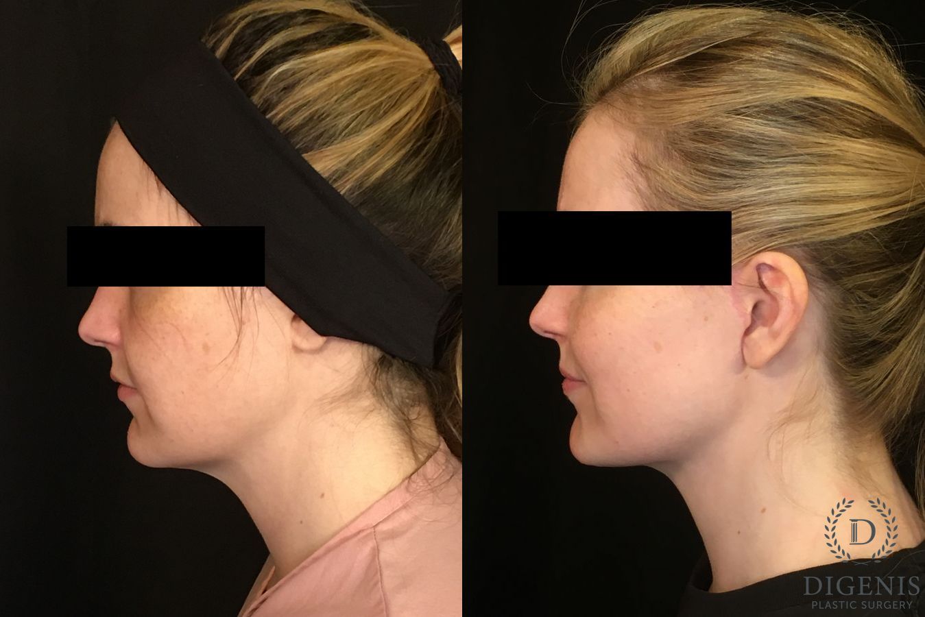 Before and after Digenis Refresh Lift case 35075 - Angle 3