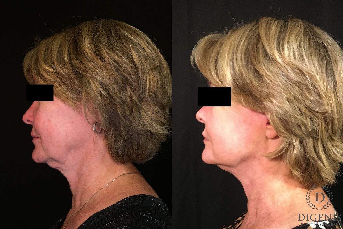 Before and after Digenis Refresh Lift case 35048 - Angle 5