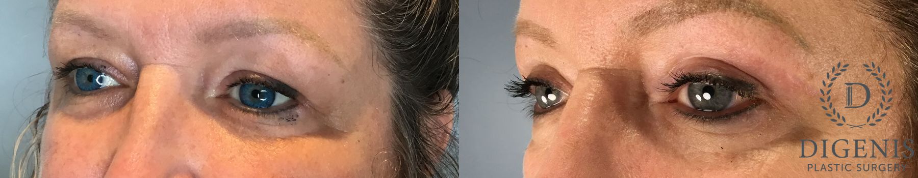 Before and after Eye Lid Surgery case 41693 - Angle 4