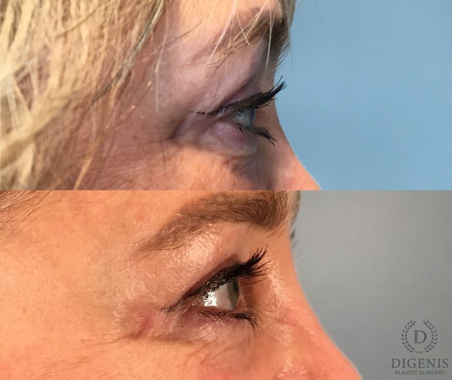 Before and after Eye Lid Surgery case 49417 - Angle 3