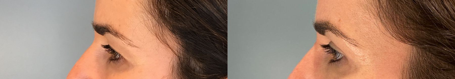 Before and after Eye Lid Surgery case 49981 - Angle 5