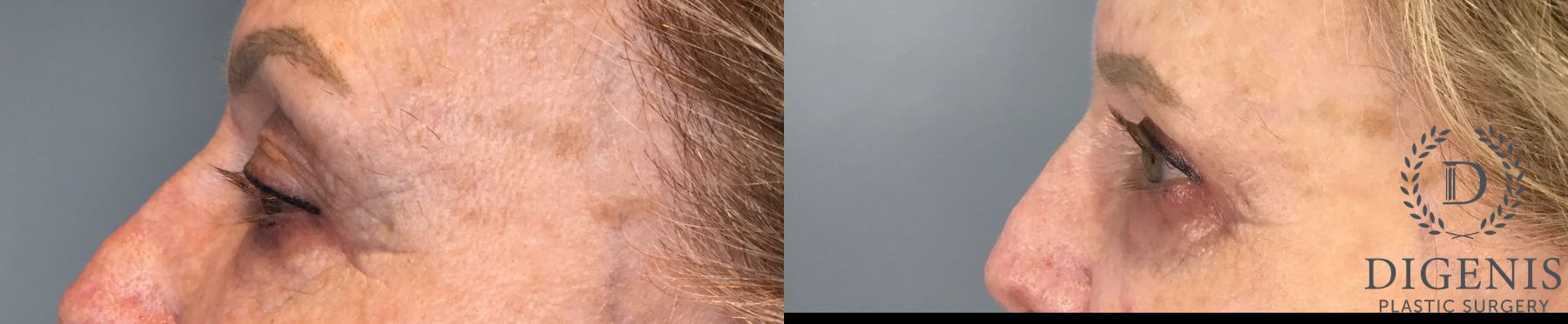 Before and after Eye Lid Surgery case 41850 - Angle 4